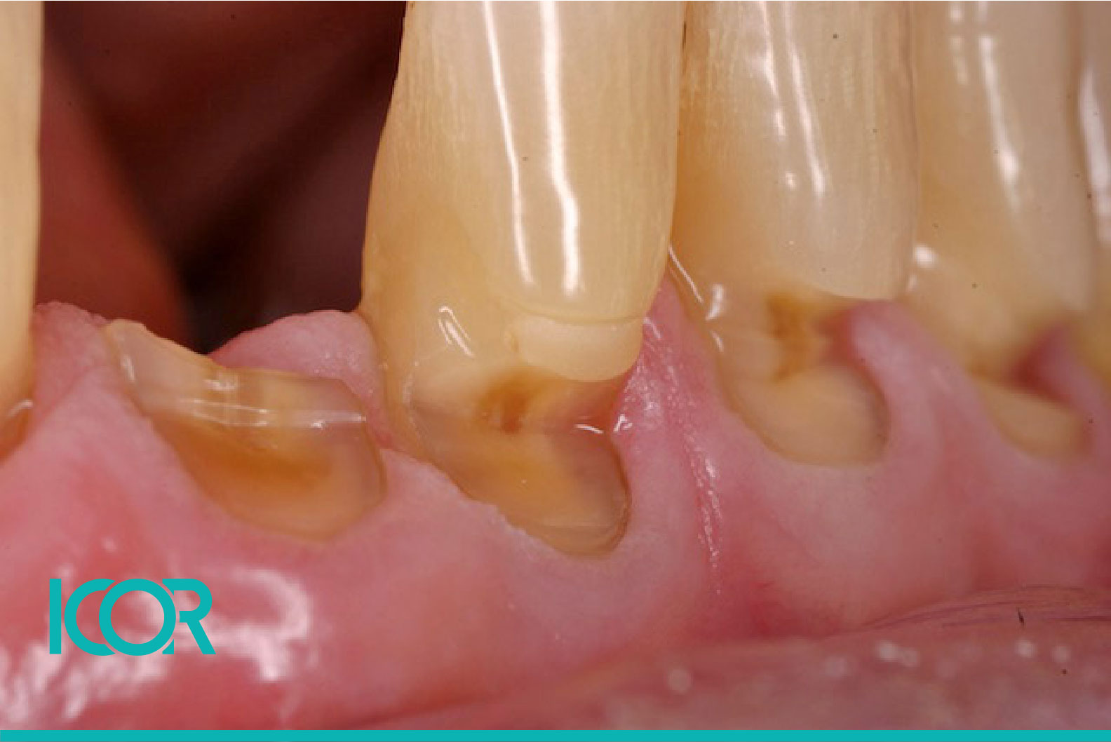 Desgaste Dentario-03