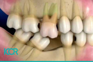 Movimiento de dientes por falta de otras piezas dentarias