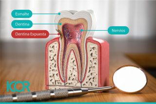 Hipersensibilidad de la dentina expuesta