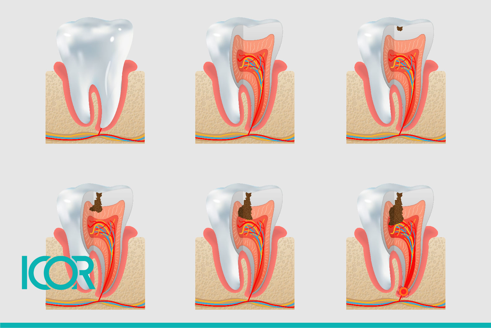 Caries y sensibilidad dental