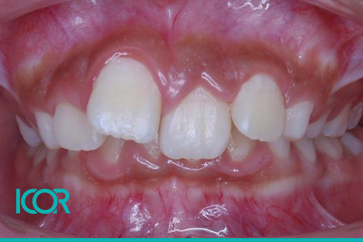 Problemas comunes ortodoncia en ninos Apinamiento dental o dientes chuecos e1634687942693