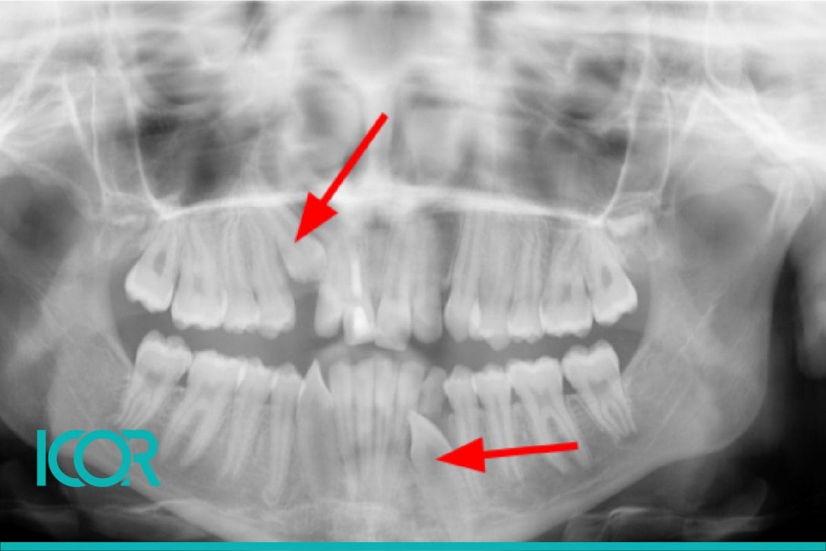 Problemas comunes ortodoncia en ninos Dientes incluidos o impactados