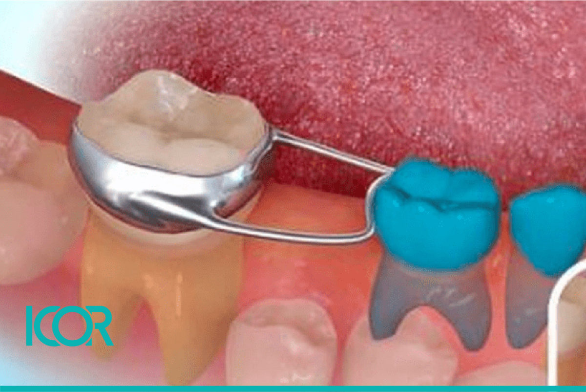Problemas comunes ortodoncia en ninos Perdida de dientes de leche e1634687984879