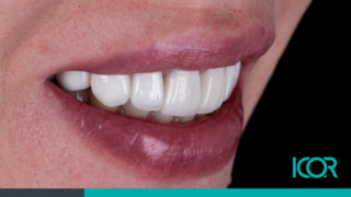Carillas dentales - Fundas dientes - ICOR