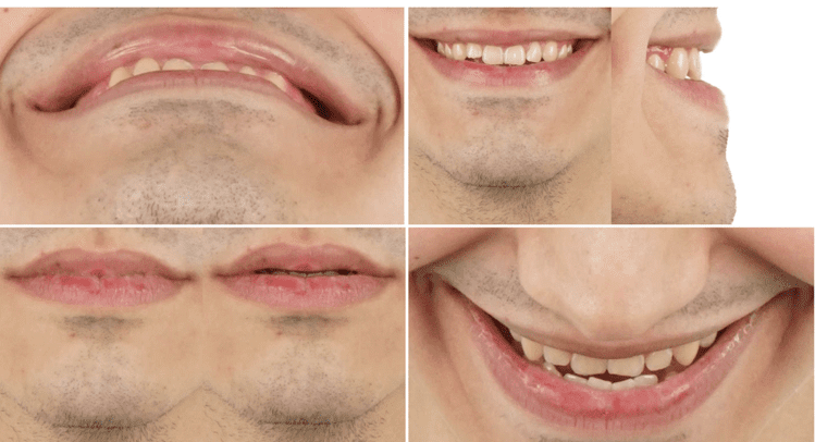 Close up de boca - Set de Fotografías extraorales de paciente quirúrgico maxilofacial