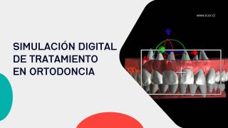 Simulación digital de tratamiento en ortodoncia