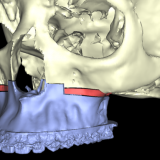 Imagen1 Colisiones Cirugia ortognatica y maxilofacial. Planificacion virtual 3D
