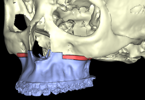 Imagen1 Colisiones Cirugia ortognatica y maxilofacial. Planificacion virtual 3D