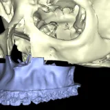Imagen2 Colisiones Cirugia ortognatica y maxilofacial. Planificacion virtual 3D