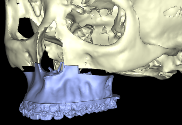 Imagen2 Colisiones Cirugia ortognatica y maxilofacial. Planificacion virtual 3D