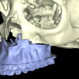 Imagen3 Colisiones Cirugia ortognatica y maxilofacial. Planificacion virtual 3D