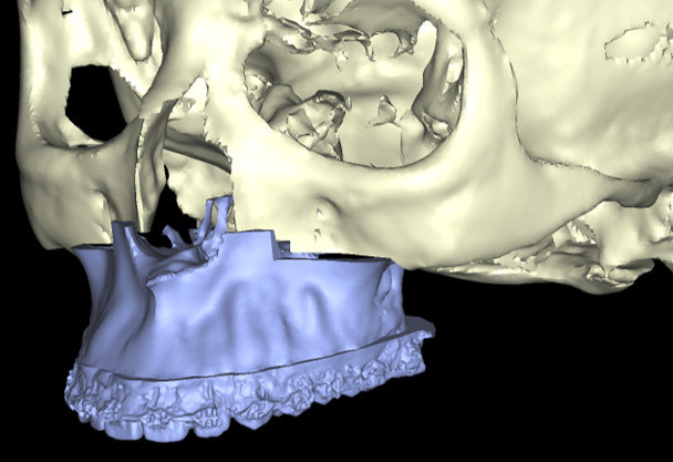 Imagen3 Colisiones Cirugia ortognatica y maxilofacial. Planificacion virtual 3D