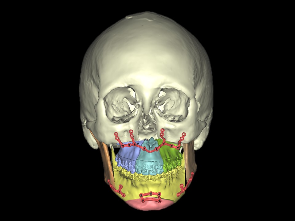 Planificación virtual de cirugía ortognática con placas hchas a media