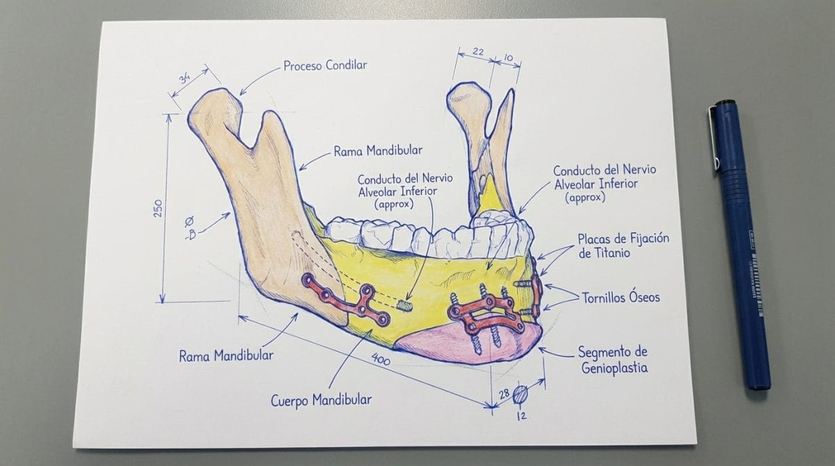 Blog 21 Placas a medida para cirugia ortognatica