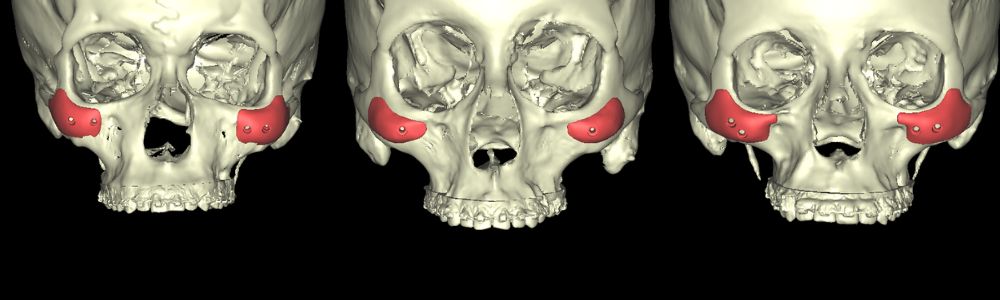 Protesis de soporte o peek contorno facial