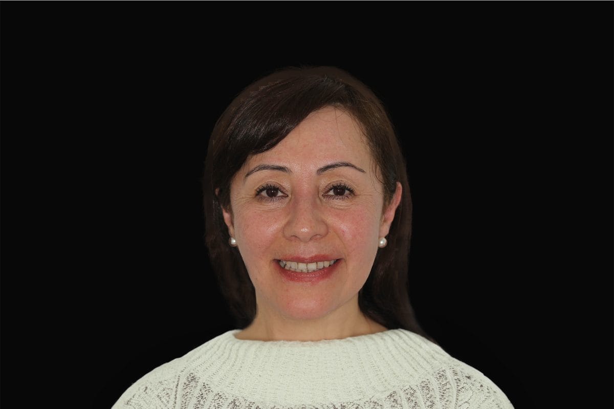 Alejandra Valenzuela, Clase II 8 Caso clínico de cirugía ortognática Clase II