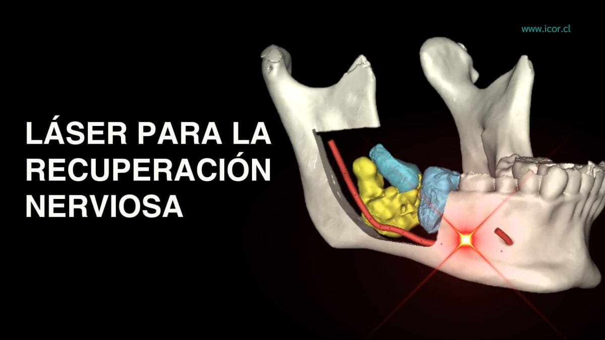 Laser para la recuperacion nerviosa por cirugia ortognatica