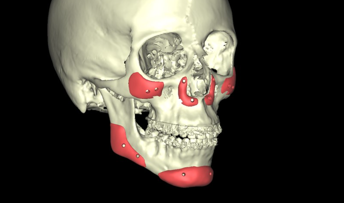 Imágen de cráneo 3D con prótesis faciales de pómulo, mentón, ángulo y paranasales.