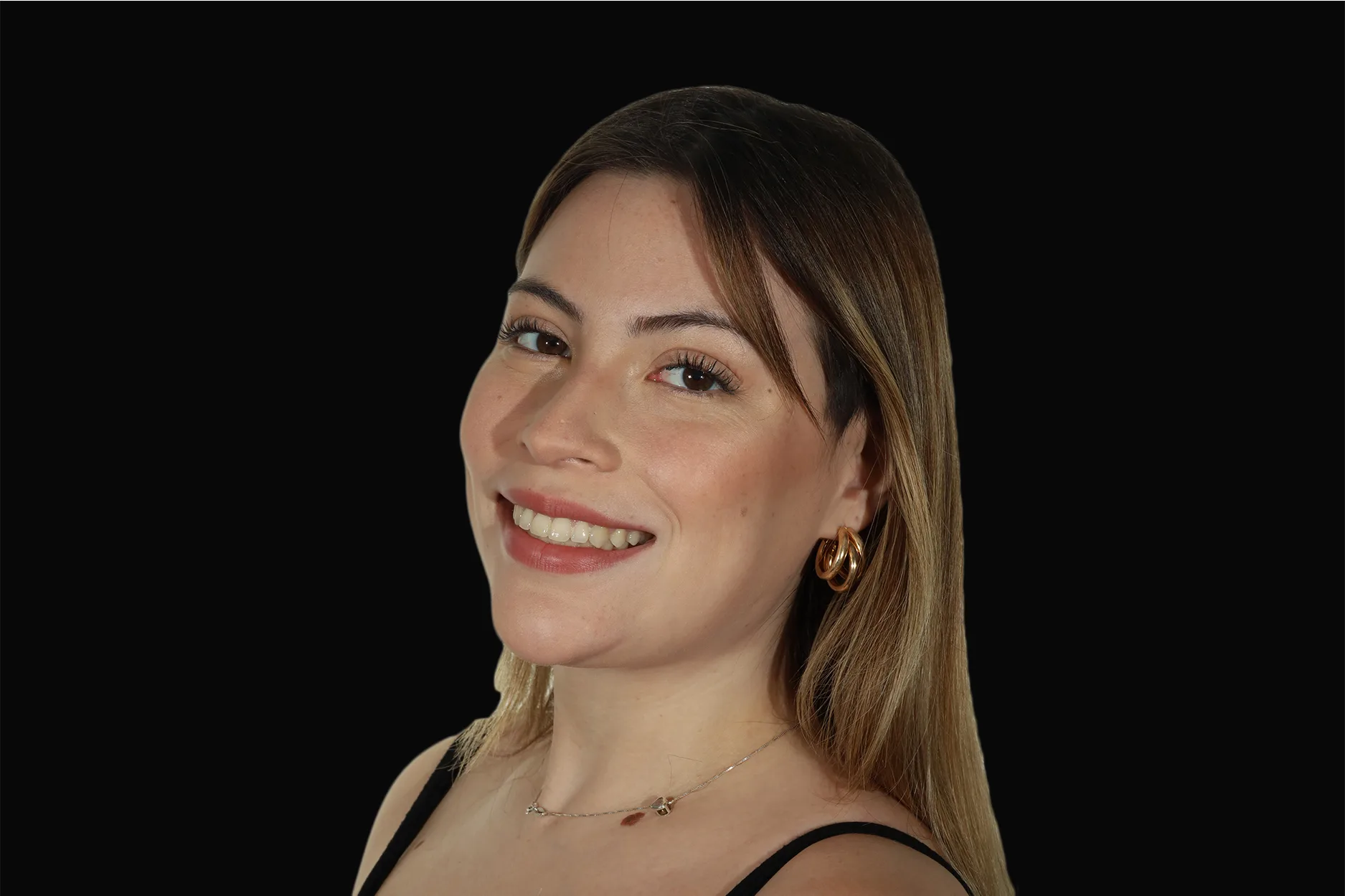 Catalina Insunza, caso clínico de cirugía ortognática de clase II + prótesis faciales de peek