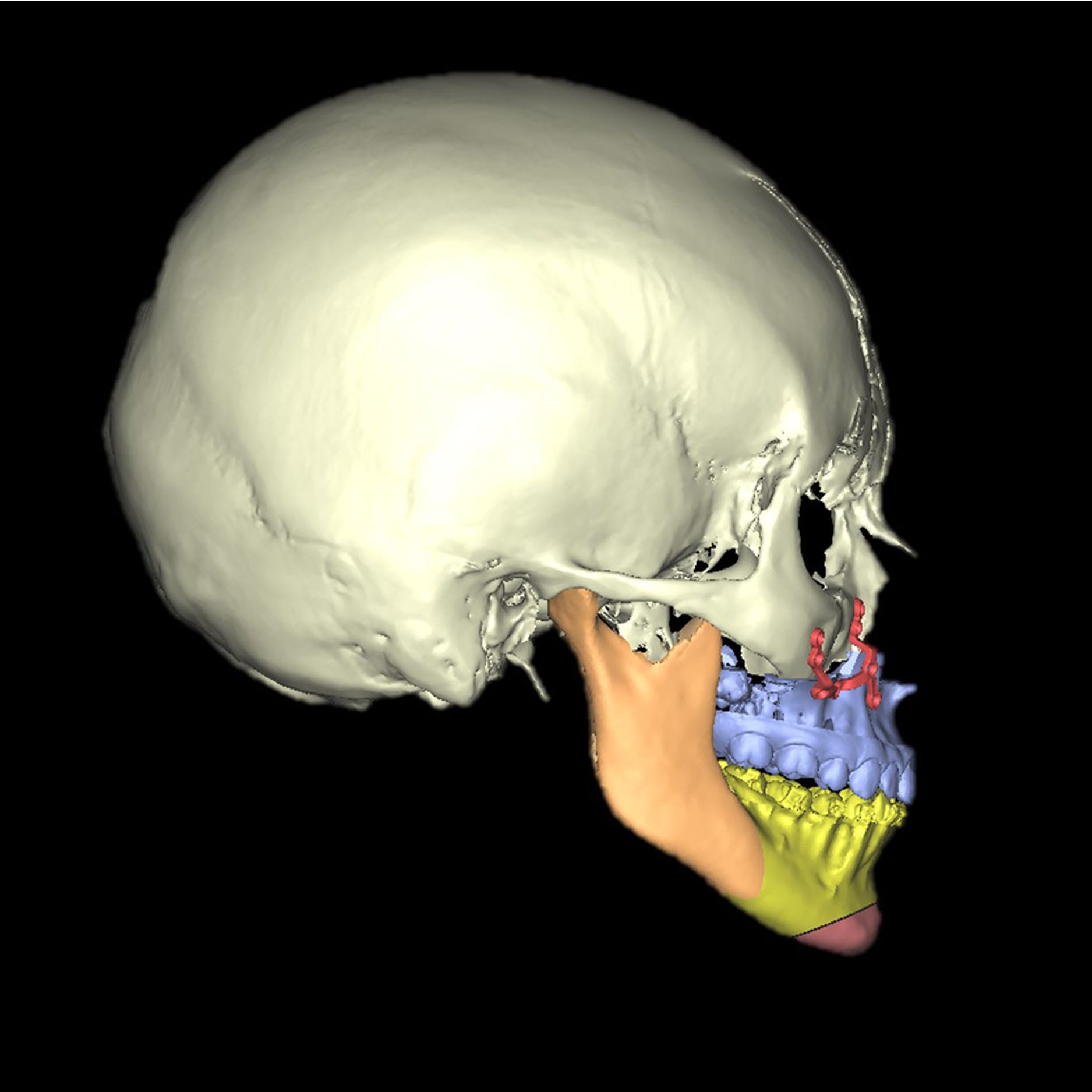 Cirugía de clase III con avance de maxilar y retroceso mandibular después