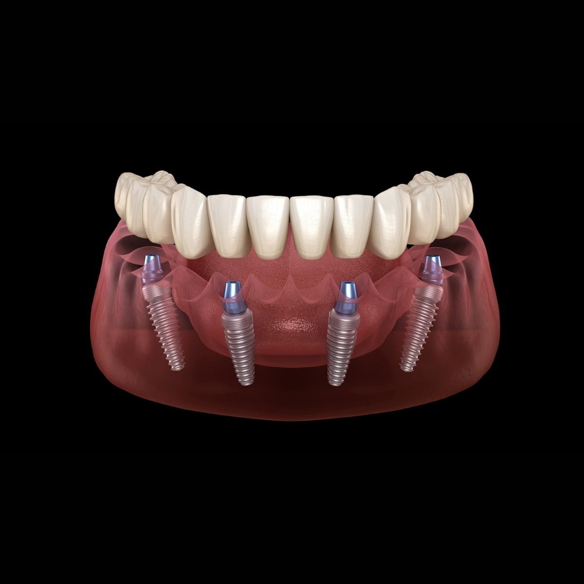Rehabilitación dental completa sostenida por implantes