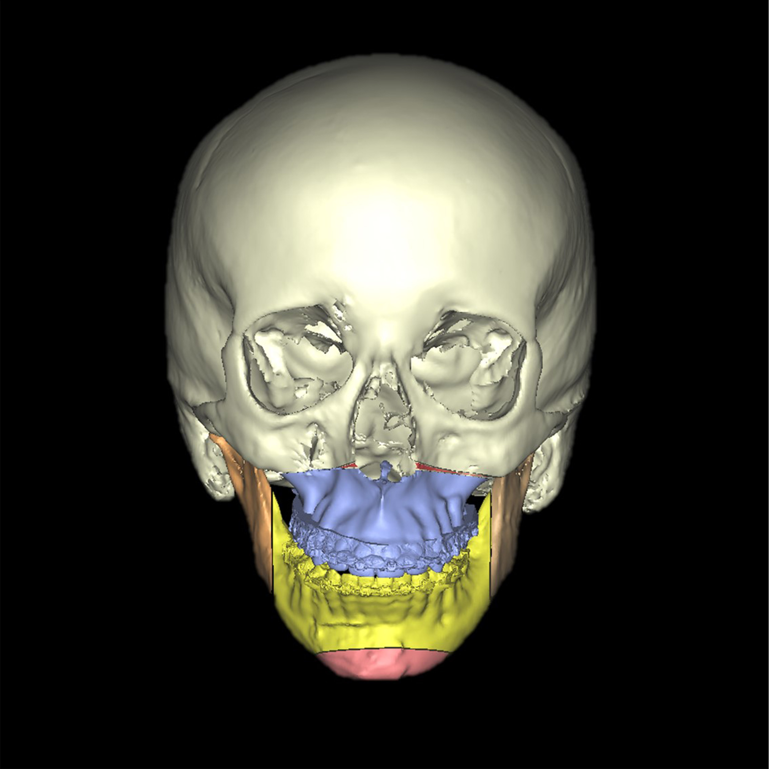 Caso de cirugía ortognatica clase II retrognatia mandibular o mandíbula hacia atrás Macarena DomingoA5