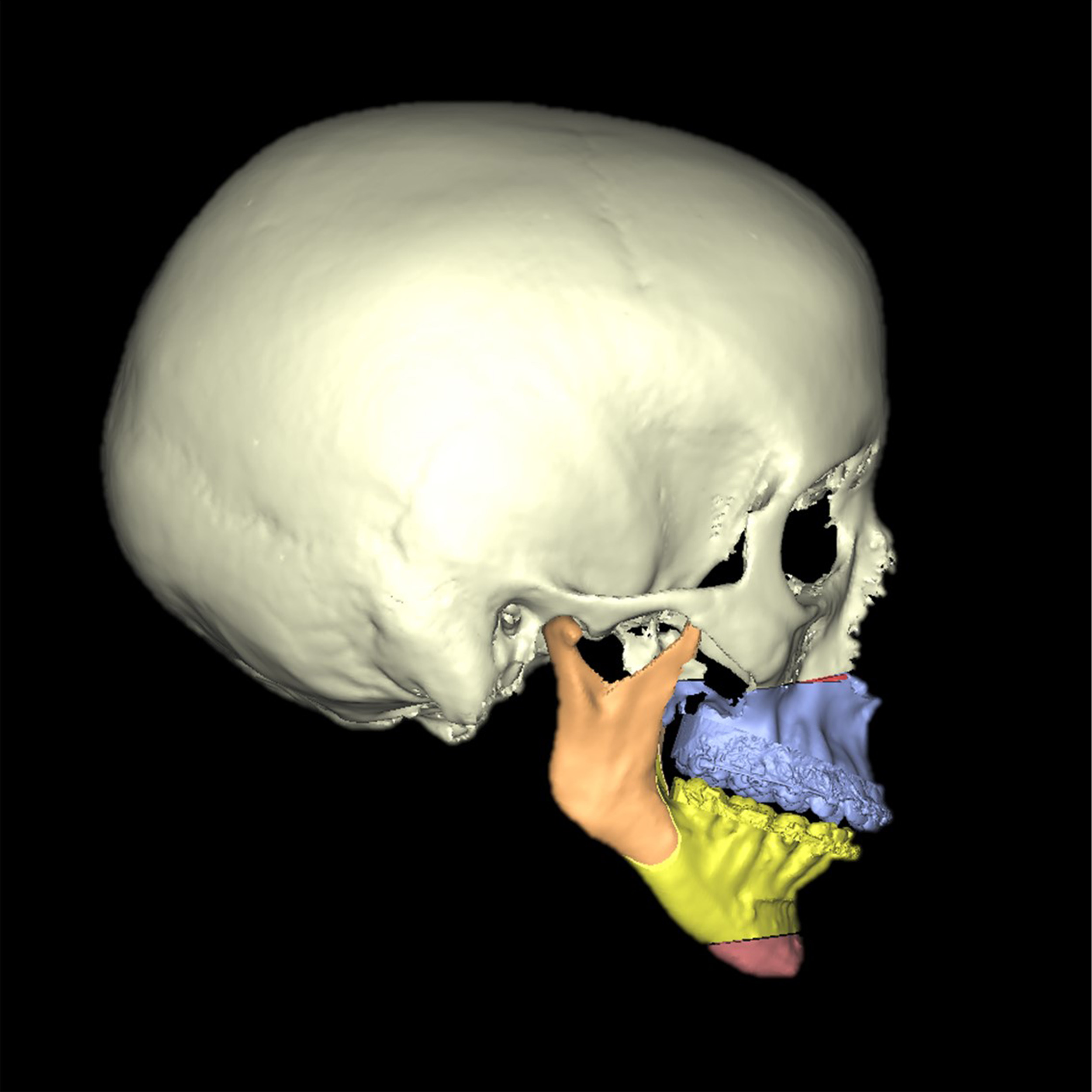 Caso de cirugía ortognatica clase II retrognatia mandibular o mandíbula hacia atrás Macarena DomingoA6