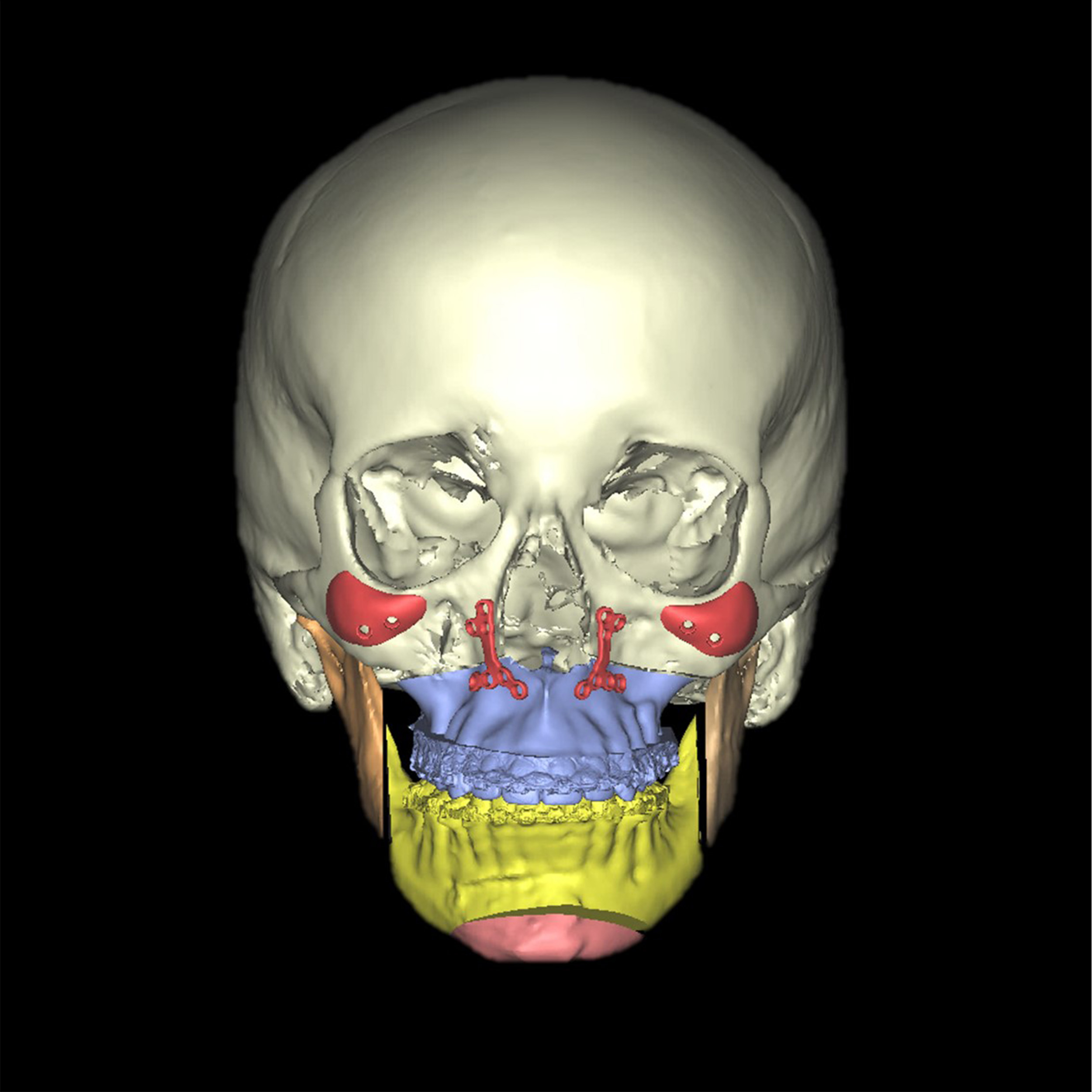 Caso de cirugía ortognatica clase II retrognatia mandibular o mandíbula hacia atrás Macarena DomingoD5