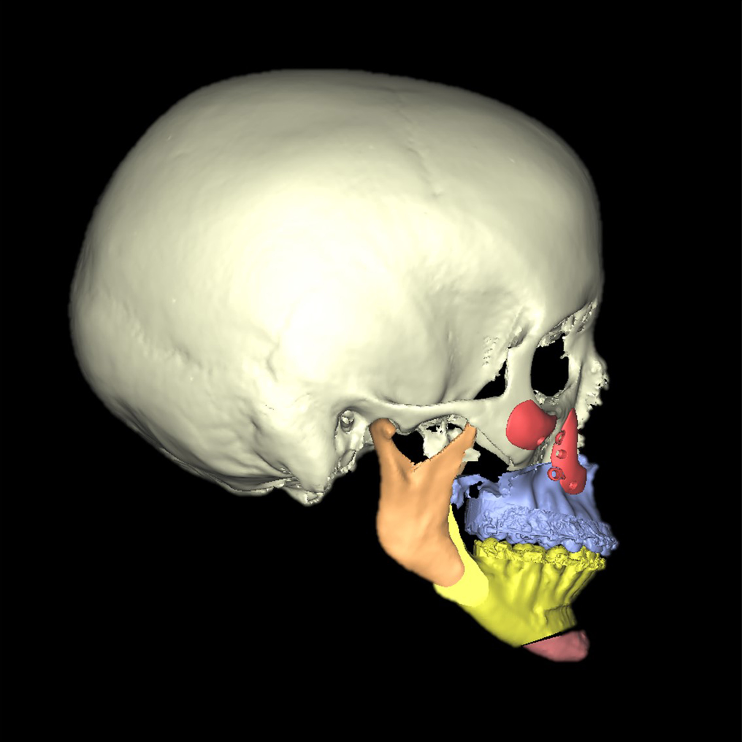 Caso de cirugía ortognatica clase II retrognatia mandibular o mandíbula hacia atrás Macarena DomingoD6