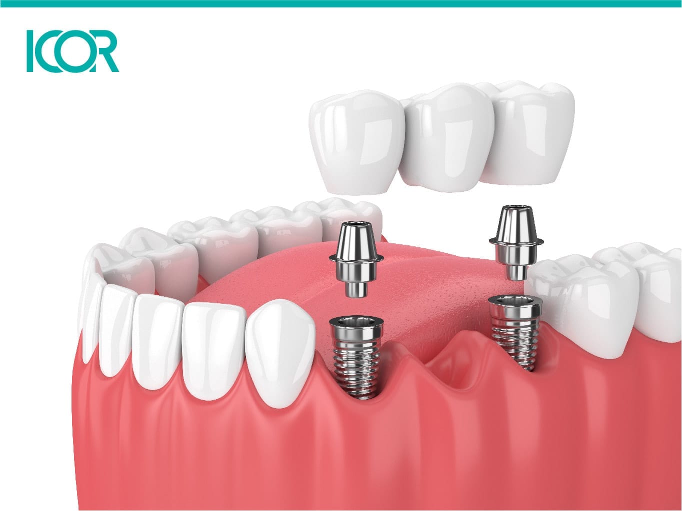 implantes dentales en varios dientes