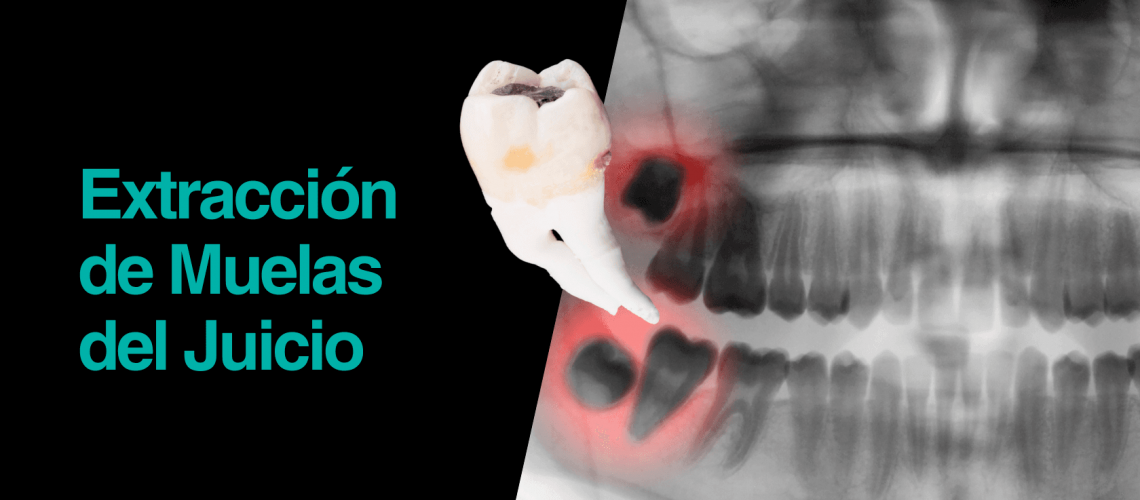 Extraccion-de-muelas-del-juicio Extraccion-de-muelas-del-juicio