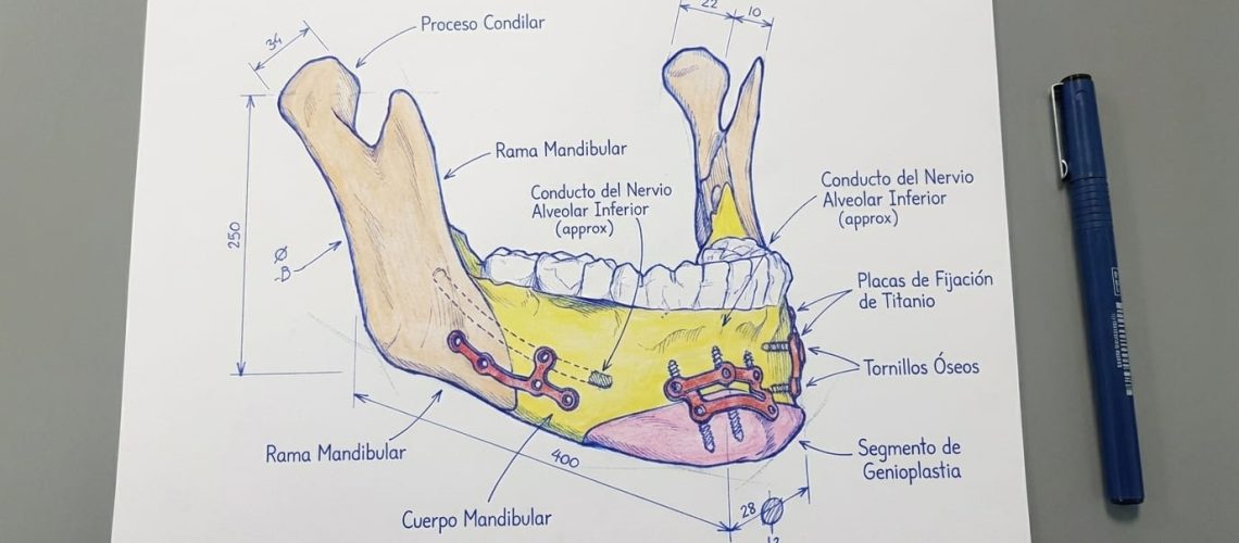 Placas a medida para cirugia ortognatica