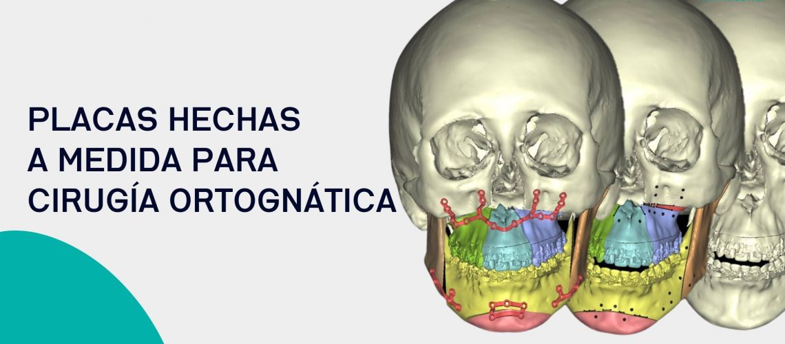 Placas-hechas-a-medida-para-cirugia-ortognatica