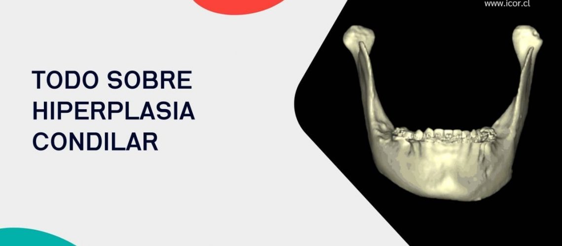 Portada Hiperplasia Condilar