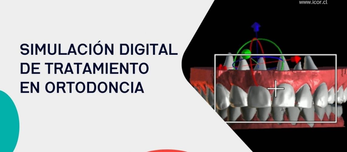 Simulacion digital de tto en ortodoncia Simulación digital de tratamiento en ortodoncia